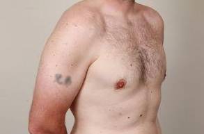after male breast reduction angle view case 4068