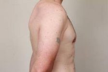 after male breast reduction side view case 4068