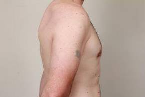 after male breast reduction side view case 4068