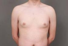 before male breast reduction front view case 4075