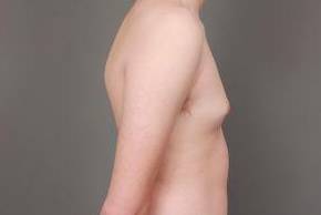 before male breast reduction right side view case 4075
