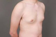 before male breast reduction front right angle view case 4075