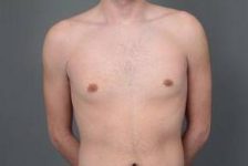 after male breast reduction front view case 4075
