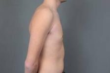 after male breast reduction right side view case 4075
