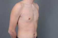 after male breast reduction front right angle view case 4075
