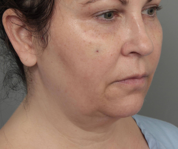 before neck contouring right angle view case 4238