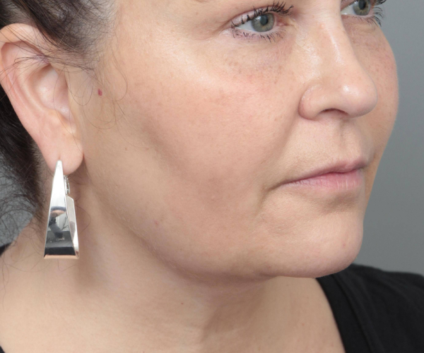 after neck contouring right angle view case 4238