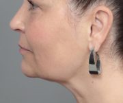 after neck contouring left side view case 4238