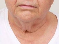 before neck contouring front view case 4266