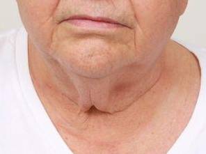 before neck contouring front view case 4266