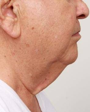 before neck contouring right side view case 4266