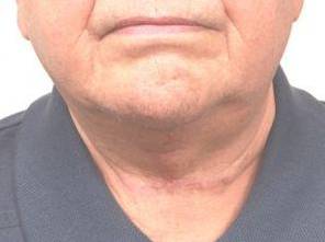after neck contouring front view case 4266