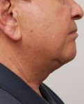 after neck contouring side view case 4266