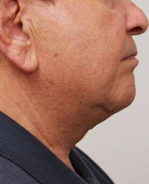 after neck contouring side view case 4266