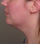 before neck contouring left side view case 4274