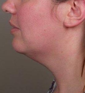 before neck contouring left side view case 4274