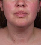 before neck contouring front view case 4274