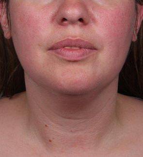 before neck contouring front view case 4274