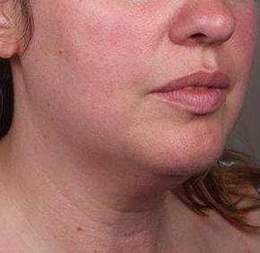 before neck contouring right angle view case 4274