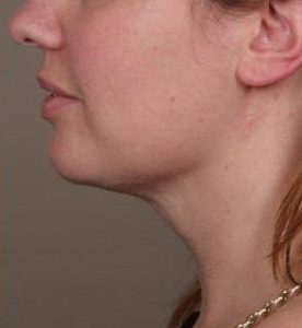 after neck contouring left side view case 4274