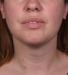 after neck contouring front view case 4274
