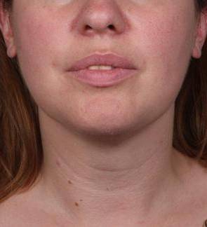 after neck contouring front view case 4274