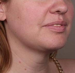 after neck contouring right angle view case 4274