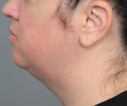 before neck contouring left side view case 4282