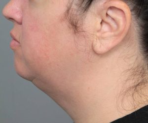 before neck contouring left side view case 4282