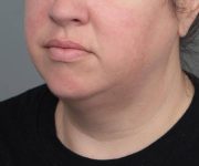 before neck contouring left angle view case 4282