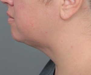 after neck contouring left side view case 4282