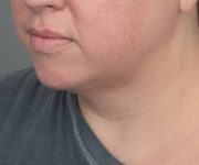 after neck contouring angle view case 4282
