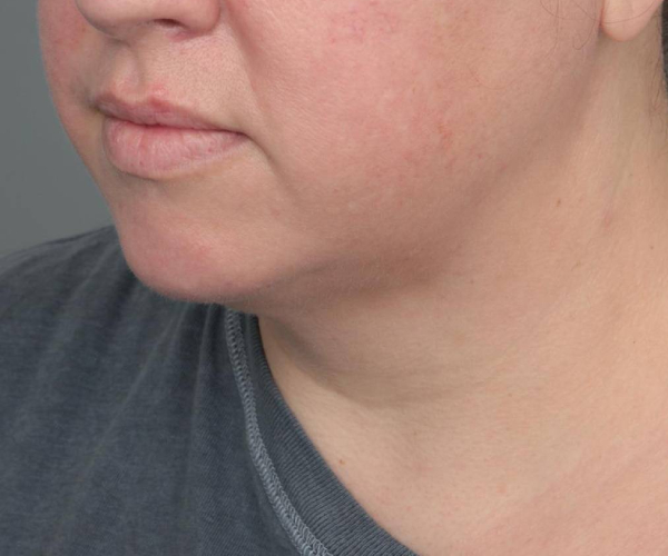 after neck contouring angle view case 4282