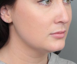 before neck contouring female patient right angle view case 4414