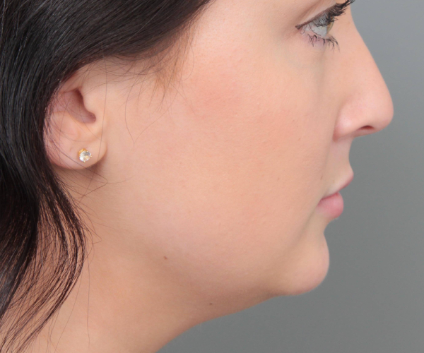 before neck contouring female patient right side view case 4414