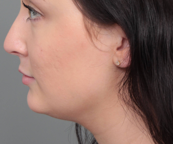 before neck contouring female patient left side view case 4414
