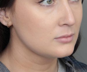 after neck contouring female patient right angle view case 4414