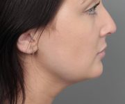 after neck contouring female patient right side view case 4414