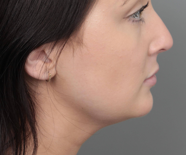 after neck contouring female patient right side view case 4414