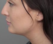 after neck contouring female patient left side view case 4414
