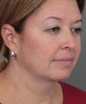 before neck contouring female patient right angle view case 4294