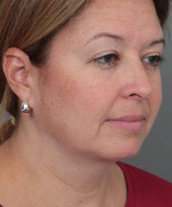 before neck contouring female patient right angle view case 4294