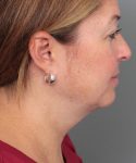 before neck contouring female patient right side view case 4294