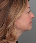 after neck contouring female patient right side view case 4294