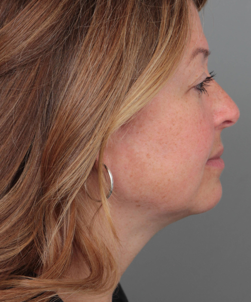 after neck contouring female patient right side view case 4294