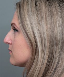 before rhinoplasty female patient left side view case 5648