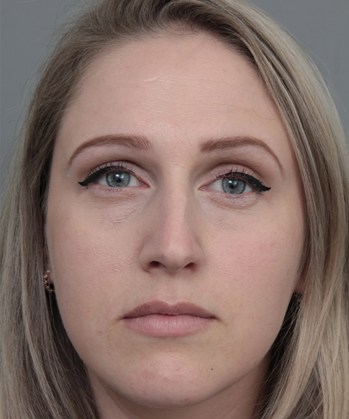 before rhinoplasty female patient front view case 5648