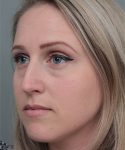 before rhinoplasty female patient left angle view case 5648