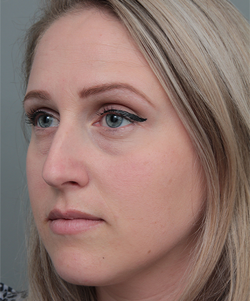before rhinoplasty female patient left angle view case 5648