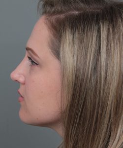 after rhinoplasty female patient left side view case 5648
